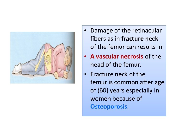  • Damage of the retinacular fibers as in fracture neck of the femur