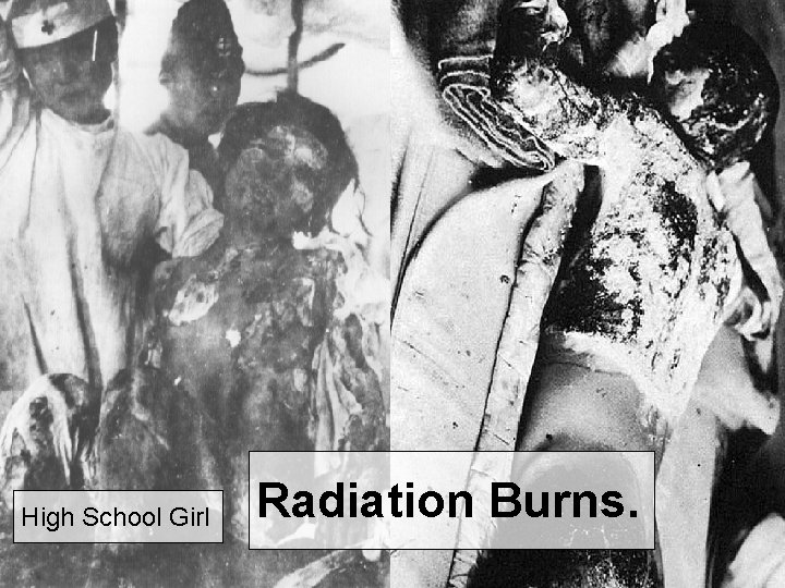 Radiation Burns High School Girl Radiation Burns. 