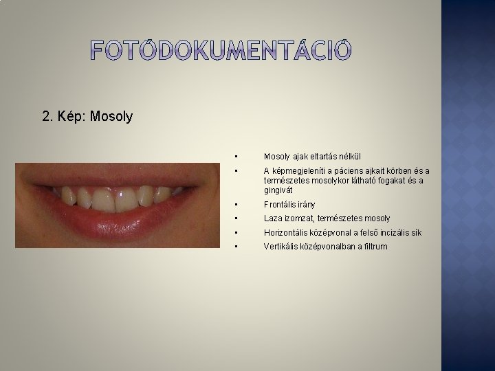2. Kép: Mosoly • Mosoly ajak eltartás nélkül • A képmegjeleníti a páciens ajkait 2. Kép: Mosoly • Mosoly ajak eltartás nélkül • A képmegjeleníti a páciens ajkait
