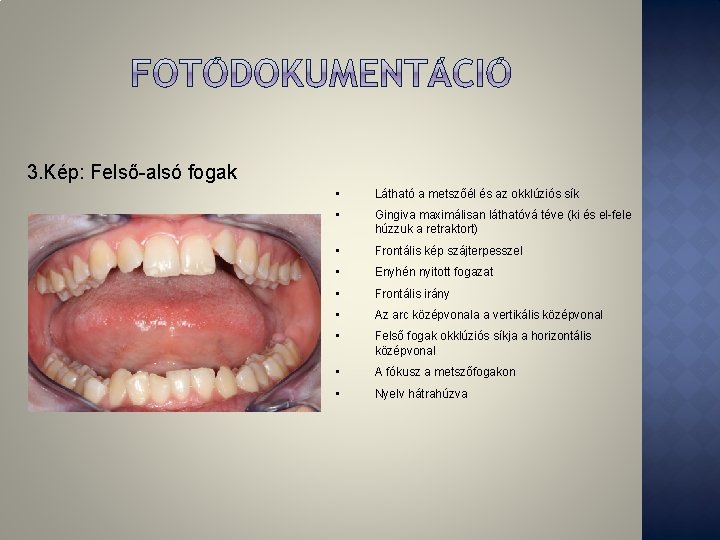 3. Kép: Felső-alsó fogak • Látható a metszőél és az okklúziós sík • Gingiva 3. Kép: Felső-alsó fogak • Látható a metszőél és az okklúziós sík • Gingiva