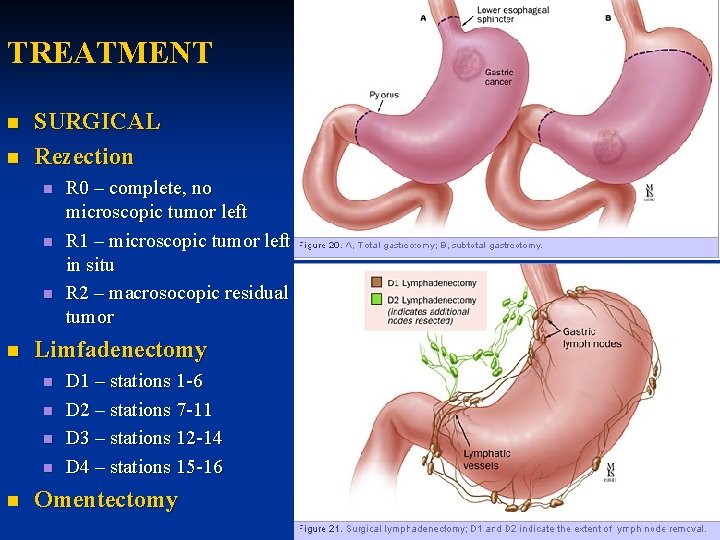 TREATMENT n n SURGICAL Rezection n n Limfadenectomy n n n R 0 –