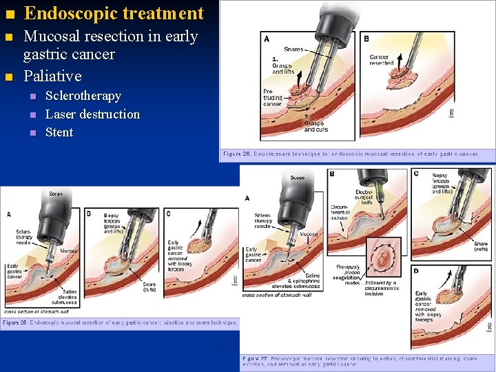 n Endoscopic treatment n Mucosal resection in early gastric cancer Paliative n n Sclerotherapy