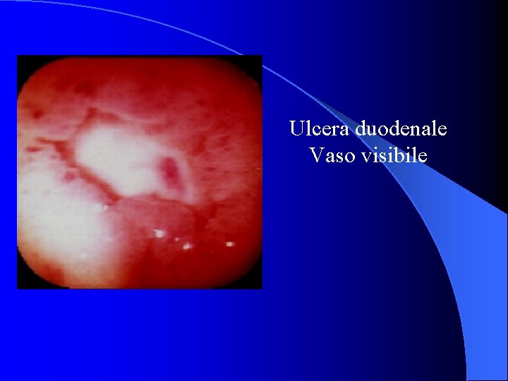 Ulcera duodenale Vaso visibile 