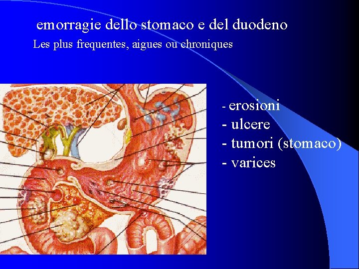 emorragie dello stomaco e del duodeno Les plus frequentes, aigues ou chroniques - erosioni