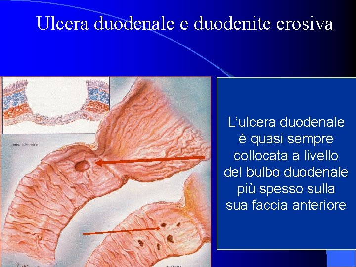 Ulcera duodenale e duodenite erosiva L’ulcera duodenale è quasi sempre collocata a livello del