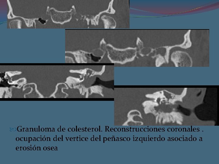  Granuloma de colesterol. Reconstrucciones coronales. ocupación del vertice del peñasco izquierdo asociado a