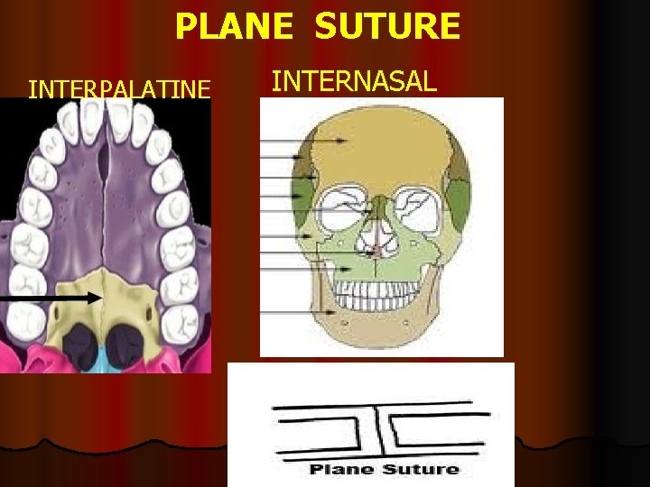 PLANE SUTURE INTERPALATINE INTERNASAL 