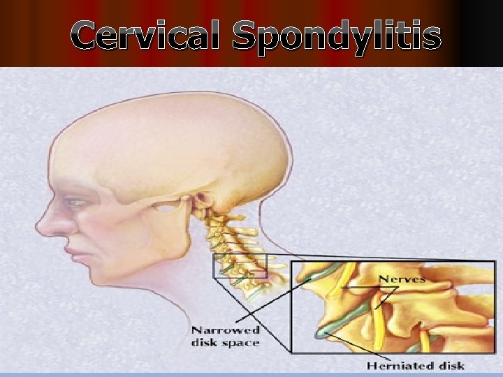 Cervical Spondylitis 