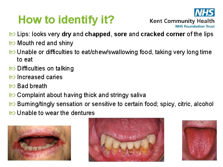 How to identify it? Lips: looks very dry and chapped, sore and cracked corner