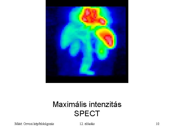 Maximális intenzitás SPECT Máté: Orvosi képfeldolgozás 12. előadás 10 