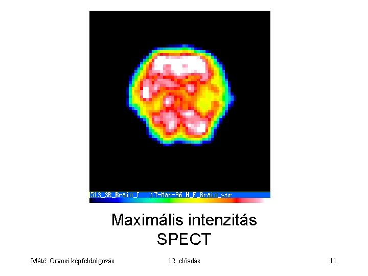 Maximális intenzitás SPECT Máté: Orvosi képfeldolgozás 12. előadás 11 