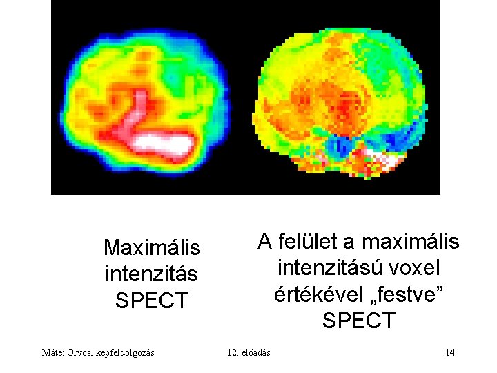 Maximális intenzitás SPECT Máté: Orvosi képfeldolgozás A felület a maximális intenzitású voxel értékével „festve”