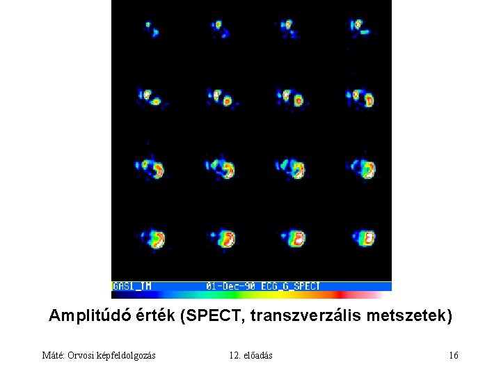 Amplitúdó érték (SPECT, transzverzális metszetek) Máté: Orvosi képfeldolgozás 12. előadás 16 