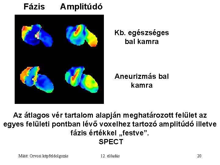 Fázis Amplitúdó Kb. egészséges bal kamra Aneurizmás bal kamra Az átlagos vér tartalom alapján