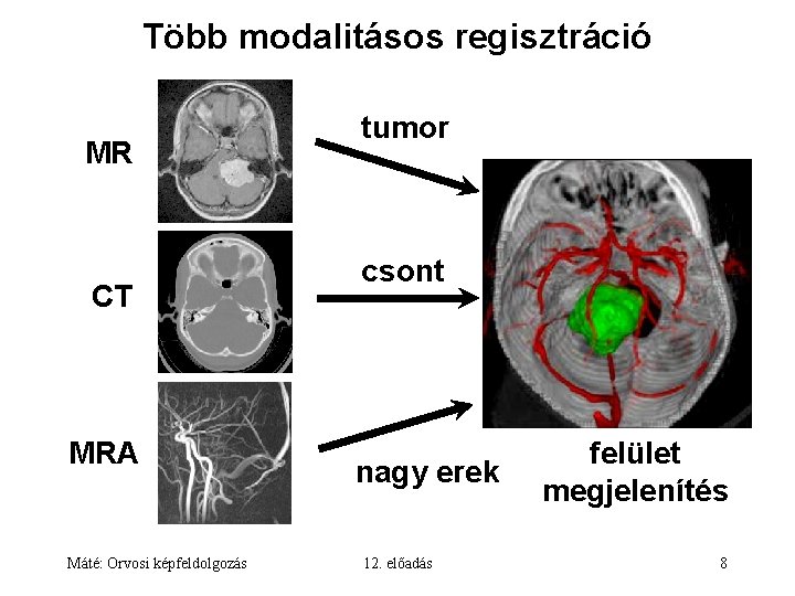 Több modalitásos regisztráció MR CT MRA Máté: Orvosi képfeldolgozás tumor csont nagy erek 12.
