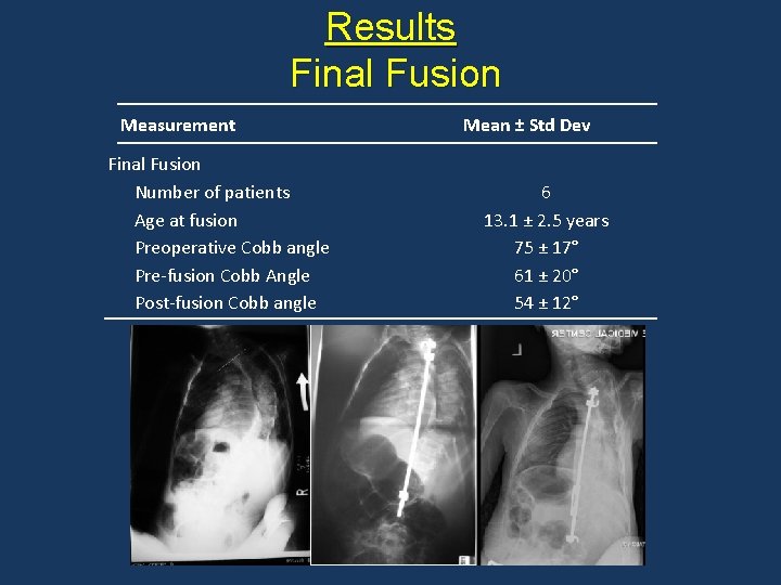 Results Final Fusion Measurement Final Fusion Number of patients Age at fusion Preoperative Cobb Results Final Fusion Measurement Final Fusion Number of patients Age at fusion Preoperative Cobb