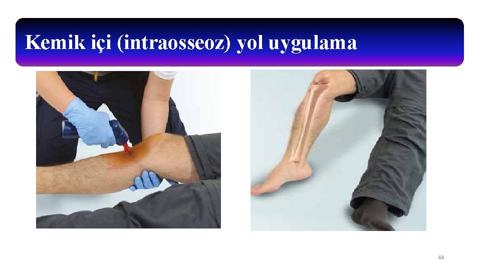 Kemik içi (intraosseoz) yol uygulama 44 