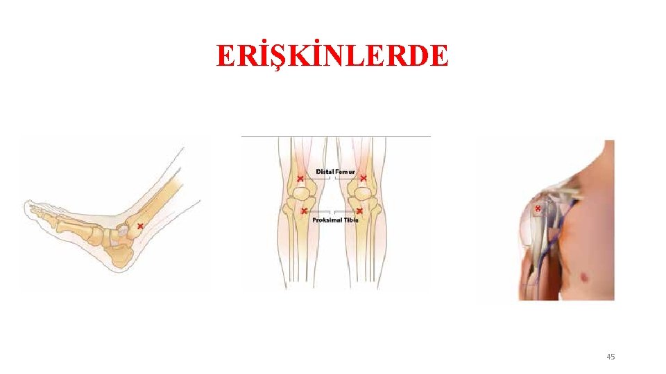 ERİŞKİNLERDE 45 