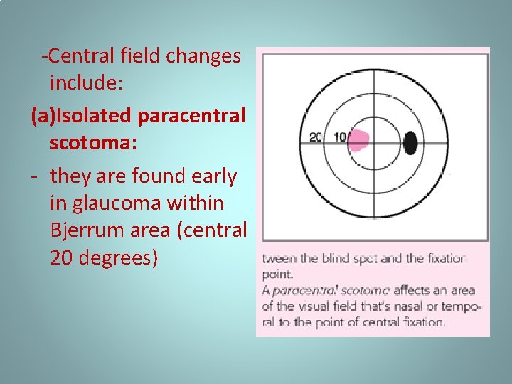 -Central field changes include: (a)Isolated paracentral scotoma: - they are found early in glaucoma