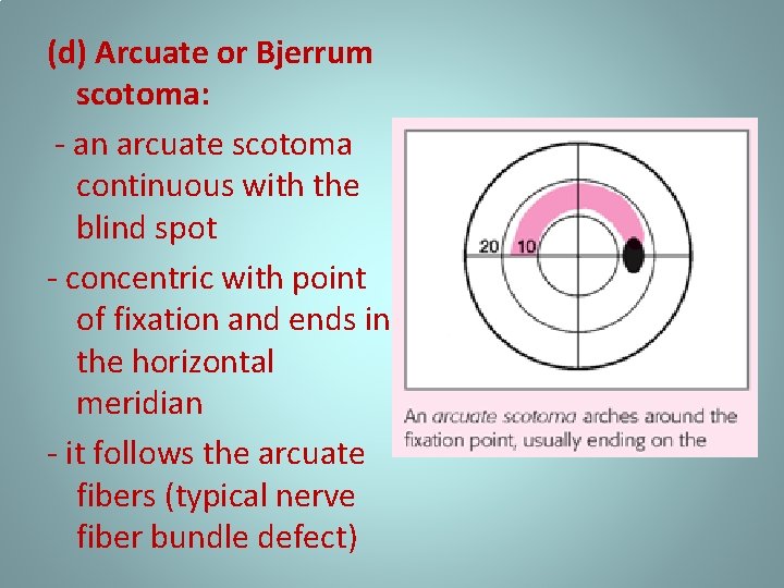 (d) Arcuate or Bjerrum scotoma: - an arcuate scotoma continuous with the blind spot