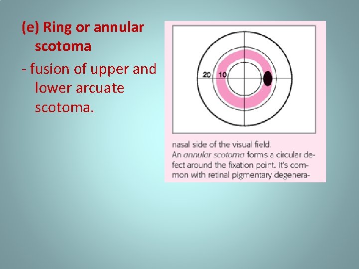 (e) Ring or annular scotoma - fusion of upper and lower arcuate scotoma. 