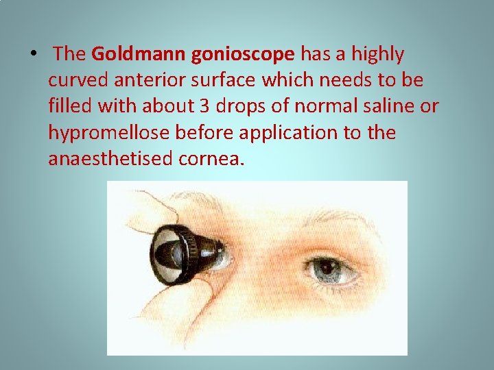  • The Goldmann gonioscope has a highly curved anterior surface which needs to