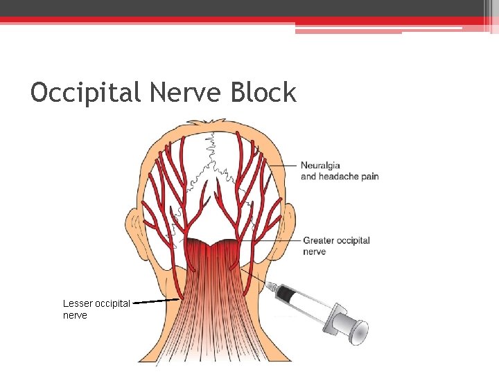 Occipital Nerve Block Lesser occipital nerve 