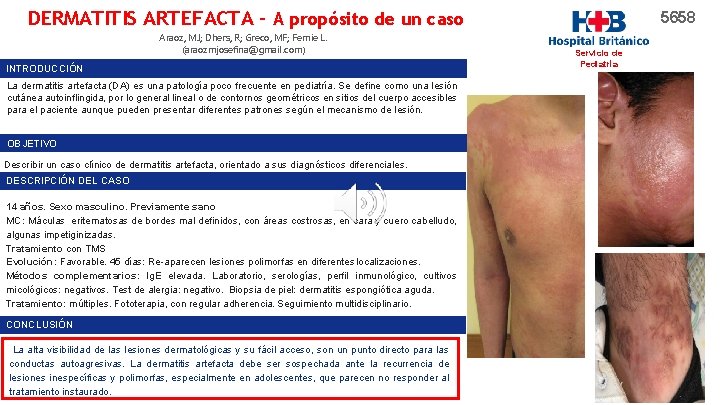 DERMATITIS ARTEFACTA - A propósito de un caso Araoz, MJ; Dhers, R; Greco, MF;