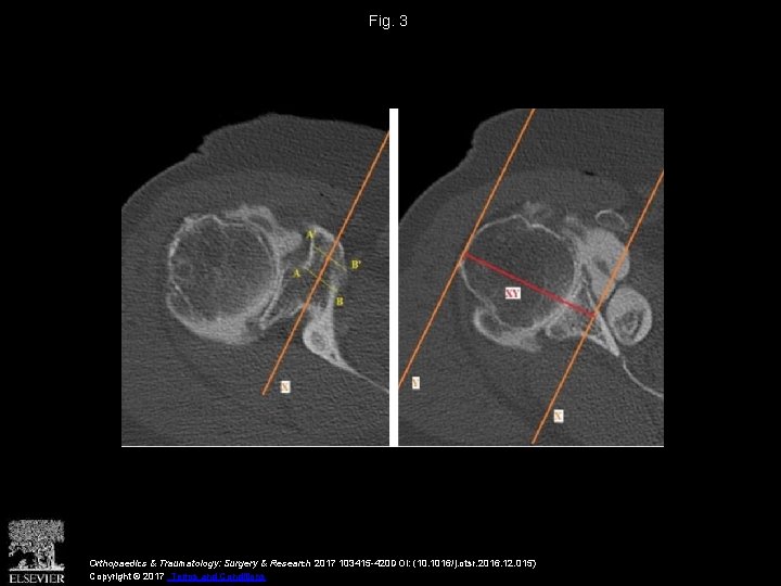 Fig. 3 Orthopaedics & Traumatology: Surgery & Research 2017 103415 -420 DOI: (10. 1016/j.