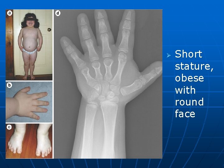 Ø Short stature, obese with round face 