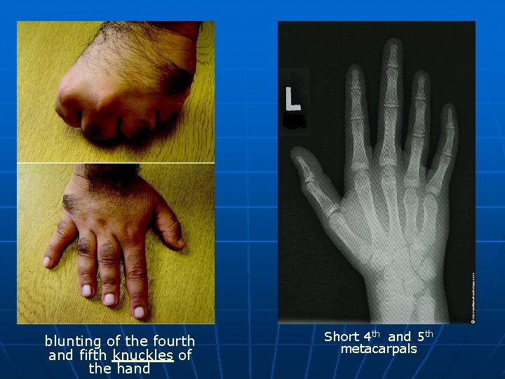 blunting of the fourth and fifth knuckles of the hand Short 4 th and