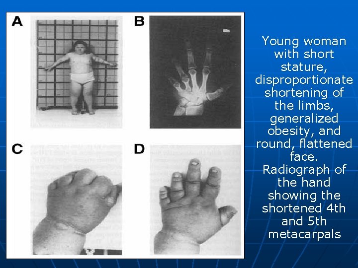 Young woman with short stature, disproportionate shortening of the limbs, generalized obesity, and round,