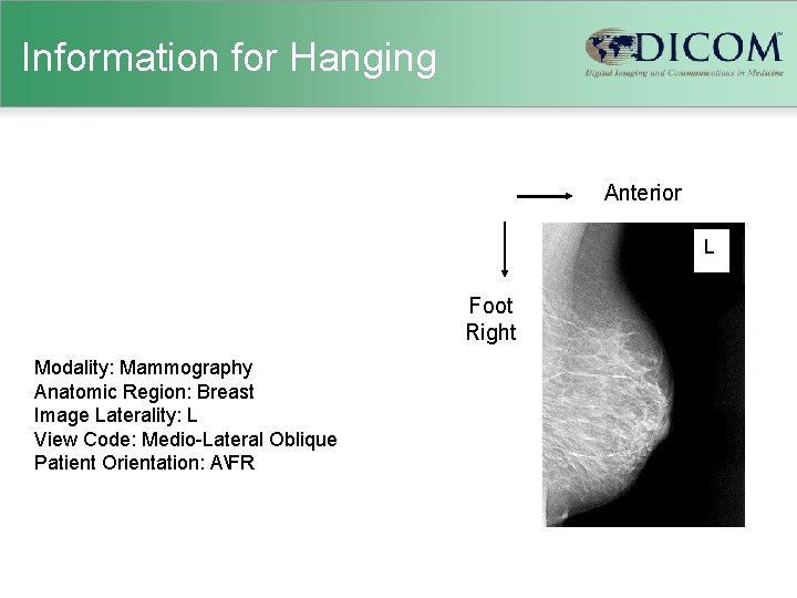 Information for Hanging Anterior L Foot Right Modality: Mammography Anatomic Region: Breast Image Laterality: