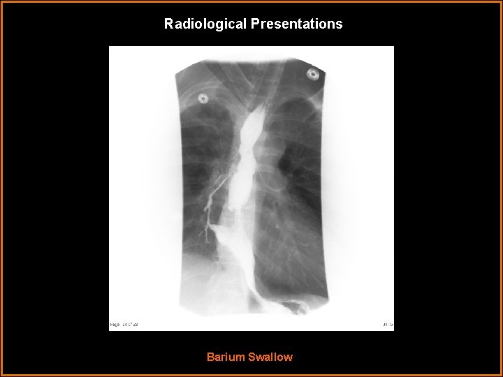 Radiological Presentations Barium Swallow 