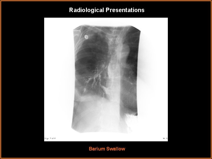 Radiological Presentations Barium Swallow 