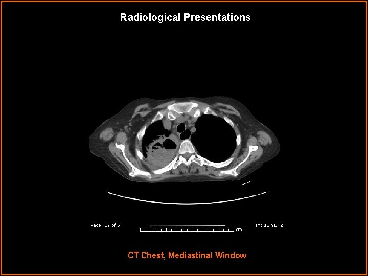 Radiological Presentations CT Chest, Mediastinal Window 