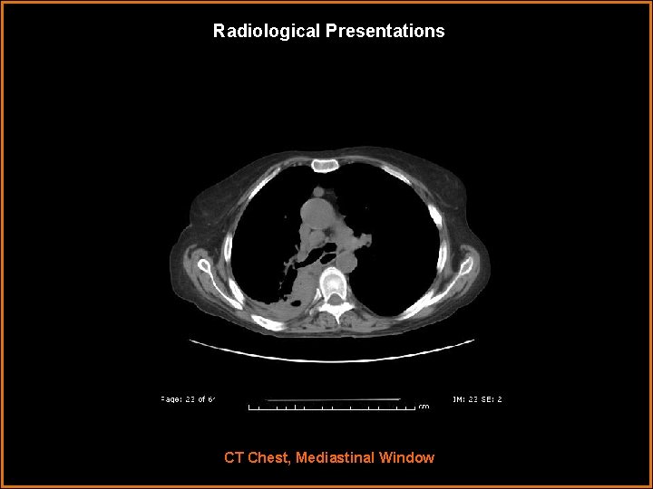 Radiological Presentations CT Chest, Mediastinal Window 