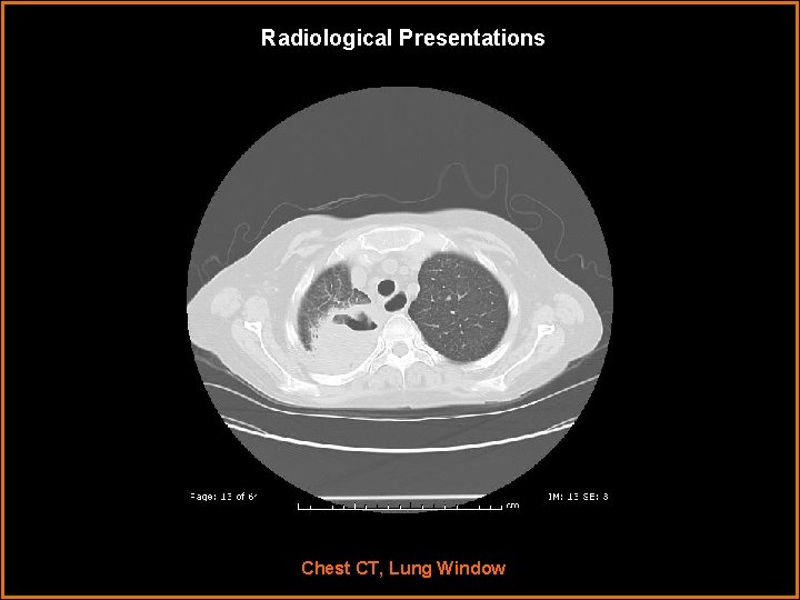 Radiological Presentations Chest CT, Lung Window 