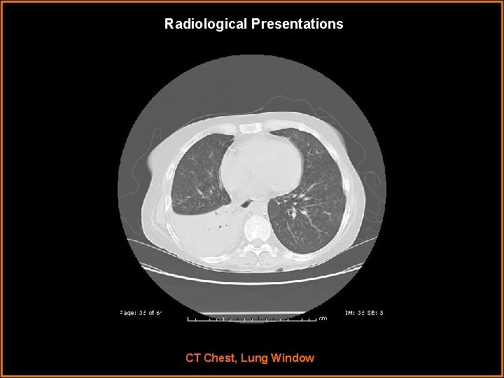 Radiological Presentations CT Chest, Lung Window 