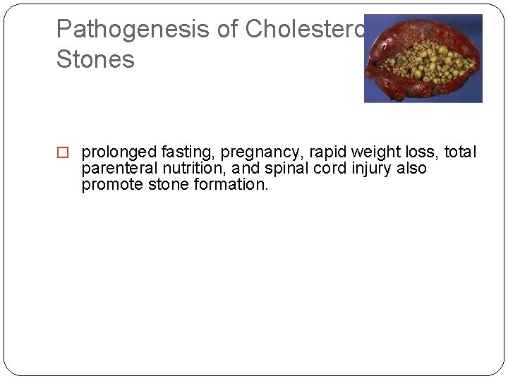 Pathogenesis of Cholesterol Stones � prolonged fasting, pregnancy, rapid weight loss, total parenteral nutrition, Pathogenesis of Cholesterol Stones � prolonged fasting, pregnancy, rapid weight loss, total parenteral nutrition,