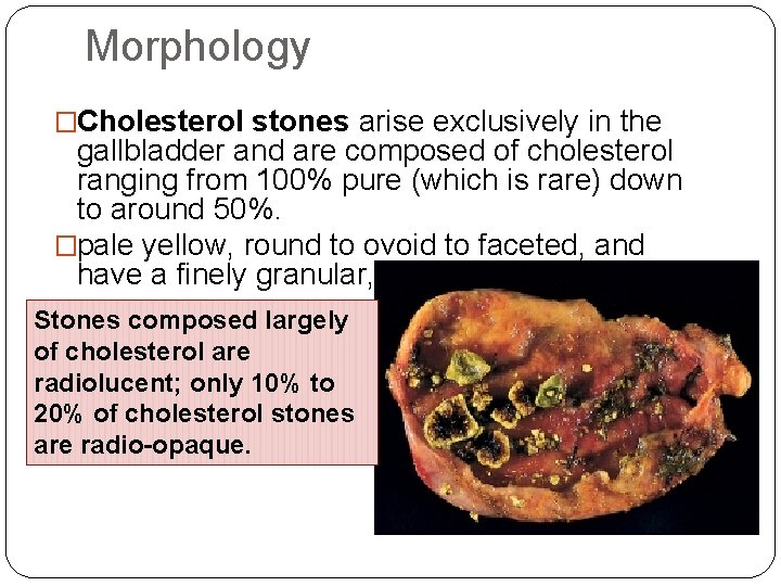 Morphology �Cholesterol stones arise exclusively in the gallbladder and are composed of cholesterol ranging Morphology �Cholesterol stones arise exclusively in the gallbladder and are composed of cholesterol ranging