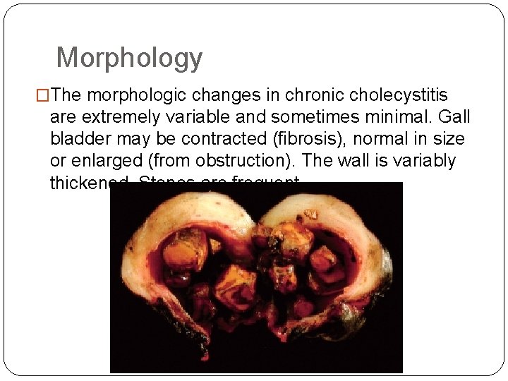 Morphology �The morphologic changes in chronic cholecystitis are extremely variable and sometimes minimal. Gall Morphology �The morphologic changes in chronic cholecystitis are extremely variable and sometimes minimal. Gall