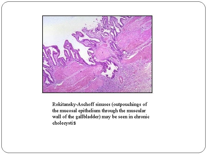 Rokitansky-Aschoff sinuses (outpouchings of the mucosal epithelium through the muscular wall of the gallbladder) Rokitansky-Aschoff sinuses (outpouchings of the mucosal epithelium through the muscular wall of the gallbladder)
