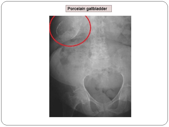 Porcelain gallbladder Porcelain gallbladder