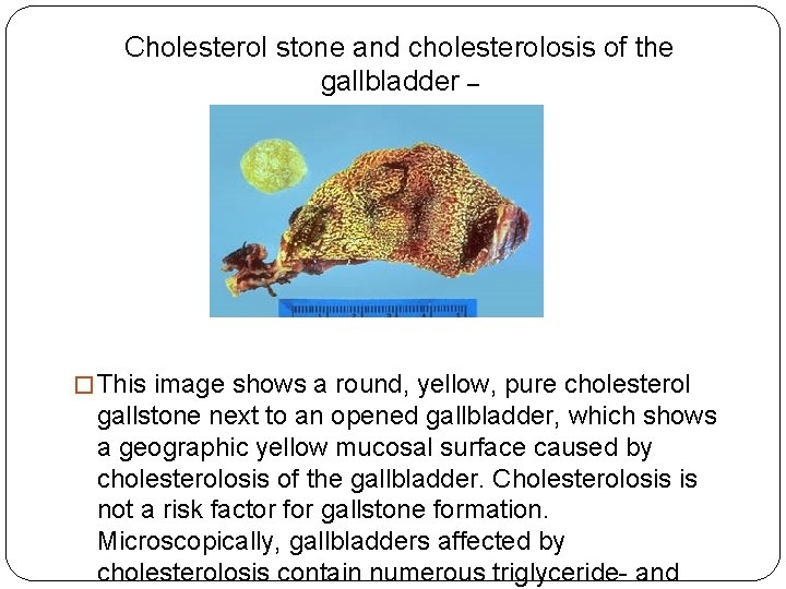 Cholesterol stone and cholesterolosis of the gallbladder – Gross, mucosal surface � This image Cholesterol stone and cholesterolosis of the gallbladder – Gross, mucosal surface � This image