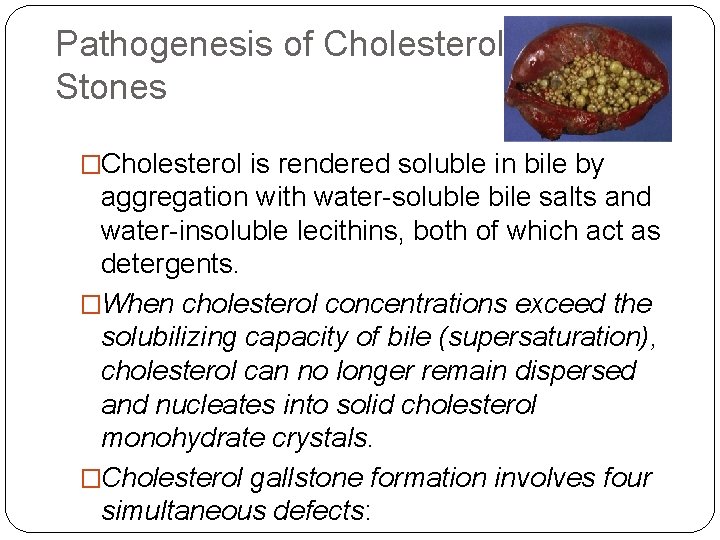 Pathogenesis of Cholesterol Stones �Cholesterol is rendered soluble in bile by aggregation with water-soluble Pathogenesis of Cholesterol Stones �Cholesterol is rendered soluble in bile by aggregation with water-soluble