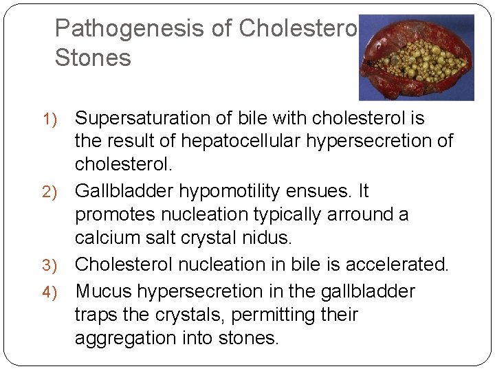 Pathogenesis of Cholesterol Stones Supersaturation of bile with cholesterol is the result of hepatocellular Pathogenesis of Cholesterol Stones Supersaturation of bile with cholesterol is the result of hepatocellular