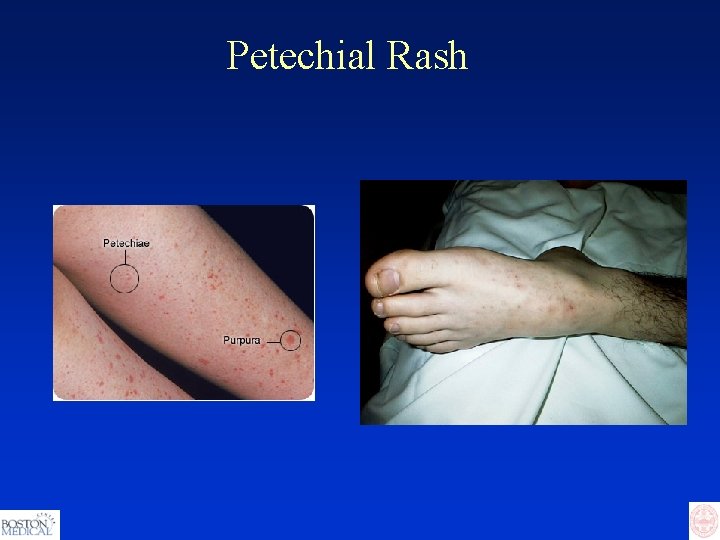 Petechial Rash 