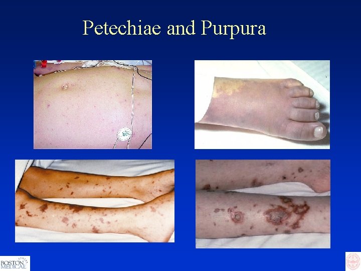 Petechiae and Purpura 