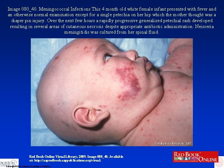 Image 080_40. Meningococcal Infections This 4 month old white female infant presented with fever